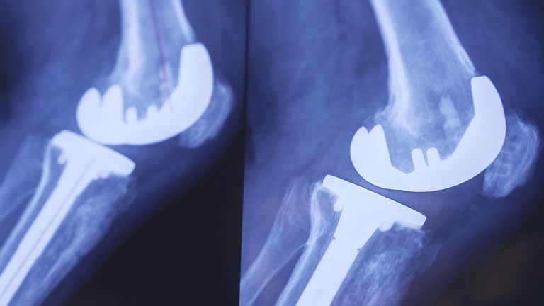 The latest data from the National Joint Replacement Registry reveals the average length of stay in hospital after a knee and hip replacement has gone down in the past 15 years. (9News)